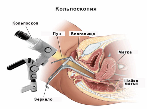 Розширена кольпоскопія з цитологією