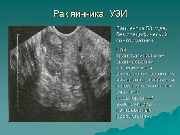 Рак яєчників: симптоми у жінок