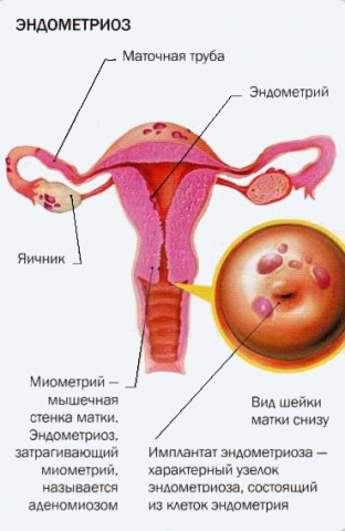 Що таке ендометріоїдна кіста шийки матки