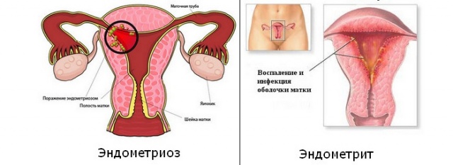 Що таке ендометріоїдна кіста шийки матки