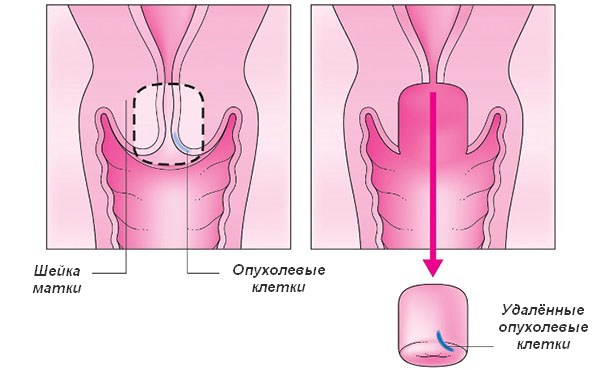 Що таке радіоексцізія шийки матки