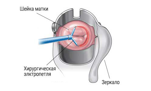 Що називають коагуляцією шийки матки