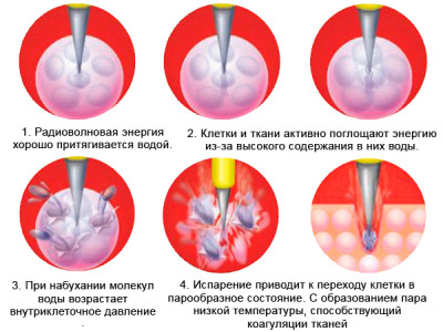 Що називають коагуляцією шийки матки