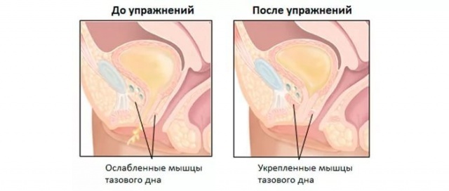 Чому з матки виходить повітря