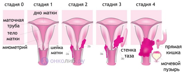 Поправді кажу вам на УЗД рак матки і шийки матки