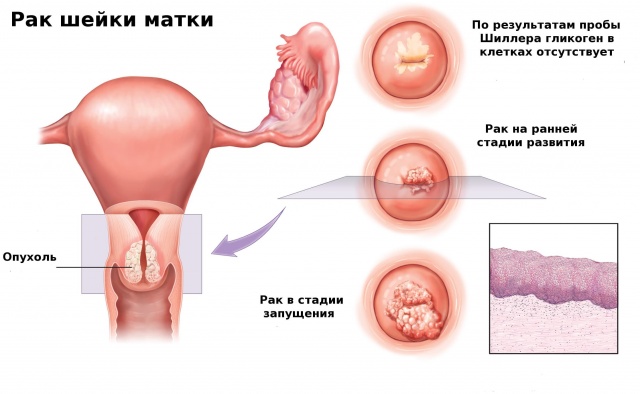 Поправді кажу вам на УЗД рак матки і шийки матки