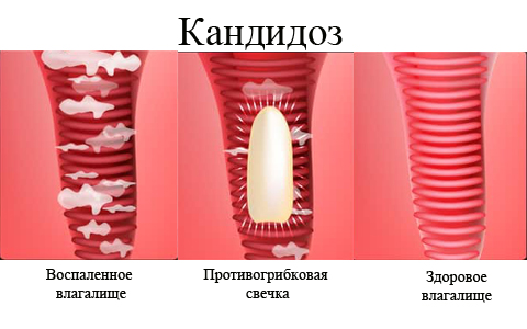 Як лікувати вагінальний кандидоз у жінок