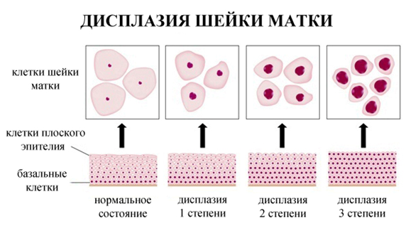 Розшифровка онкоцитологію шийки матки