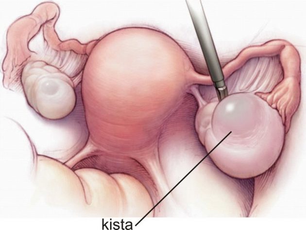 Лапаротомія кісти яєчника
