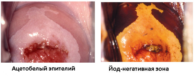 Кольпоскопическое дослідження шийки матки