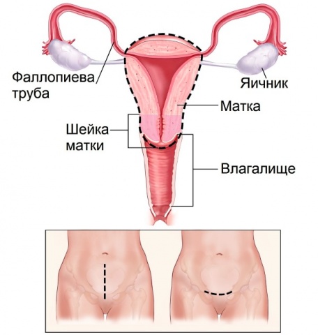 Що таке ампутація матки