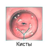 Видалення кісти шийки матки