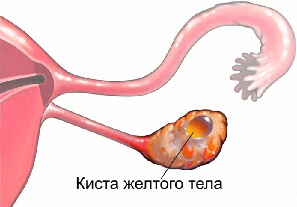 Кровотеча при кісті яєчника: що робити