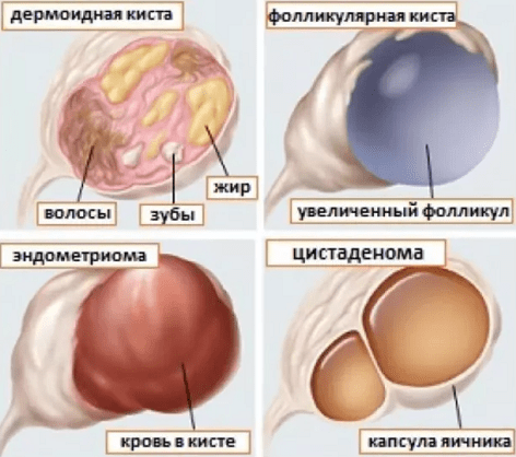 Кровотеча при кісті яєчника: що робити