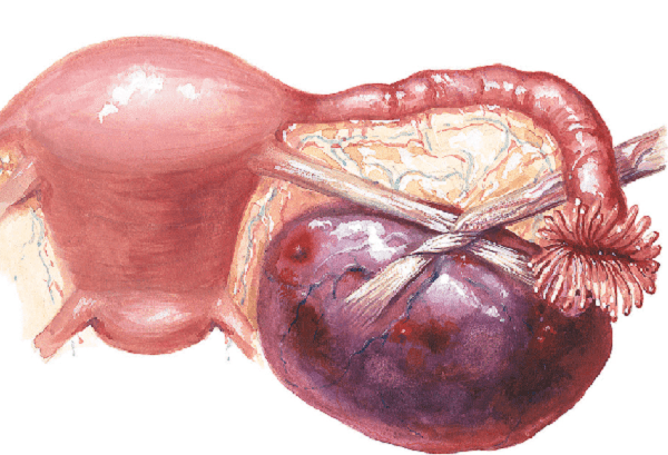 Кровотеча при кісті яєчника: що робити