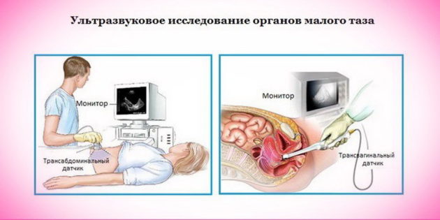 Чому 2 рази в місяць йдуть місячні