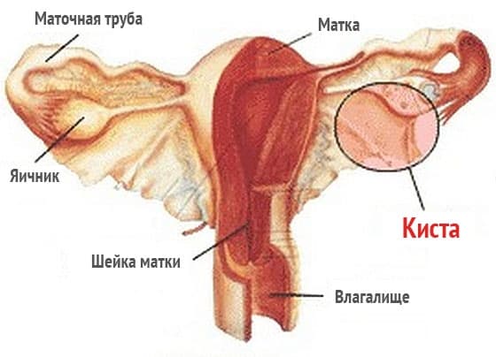 Чи небезпечна кіста круглої зв'язки на матці