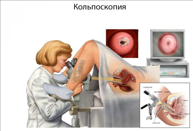 Що показує кольпоскопія шийки матки