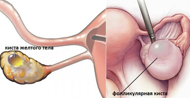 Функціональна кіста правого і лівого яєчника