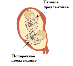 Що означає грушоподібна форма матки