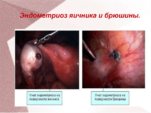 Аденоміоз яєчника: що це