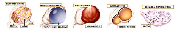 Які розміри кісти яєчника вважаються великими