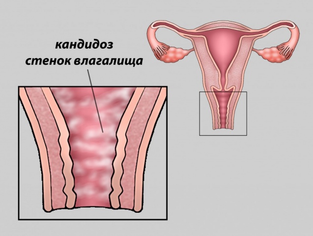 Чи може при молочниці хворіти низ живота