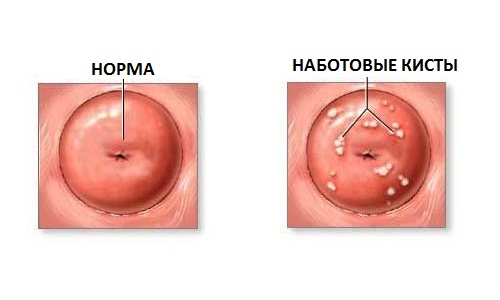 Причини виникнення пензлика на шийці матки