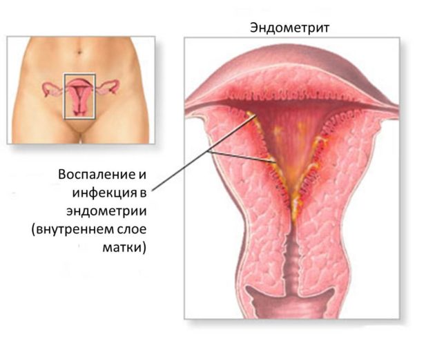 Рясні місячні зі згустками