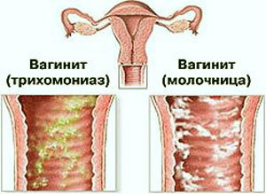 Чи допомагає від молочниці Трихопол