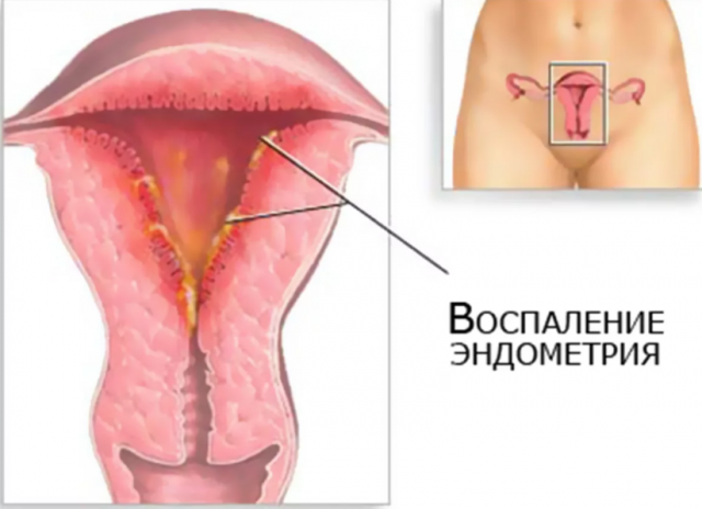 Чому не росте ендометрій