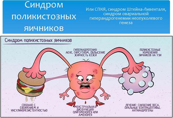 Гиперандрогения яєчникового генезу