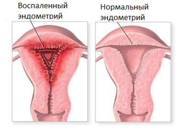 Кров'яні виділення в середині циклу