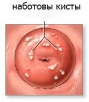 Чи небезпечна кіста шийки матки