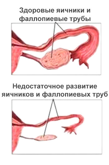 Гіпоплазія яєчників у жінок