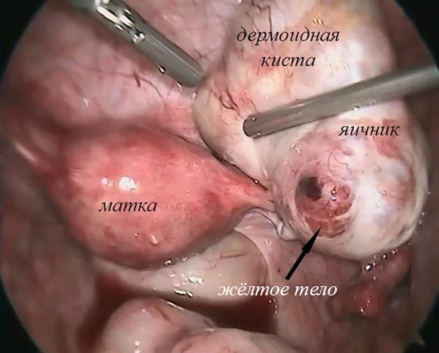 Місячні після лапароскопії яєчників