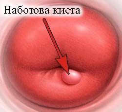 Видалення кісти шийки матки