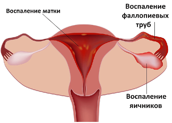 Ендометріоїдна кіста лівого і правого яєчника