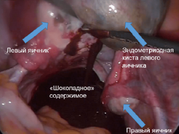 Ендометріоїдна кіста лівого і правого яєчника