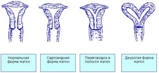 Форми матки у жінок