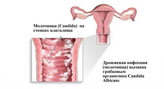 Лікування молочниці засобами народної медицини