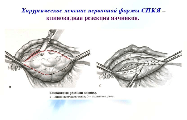 Клиноподібна резекція яєчників