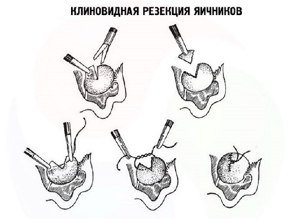 Клиноподібна резекція яєчників