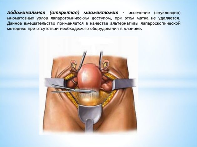 Чи йдуть місячні після видалення матки