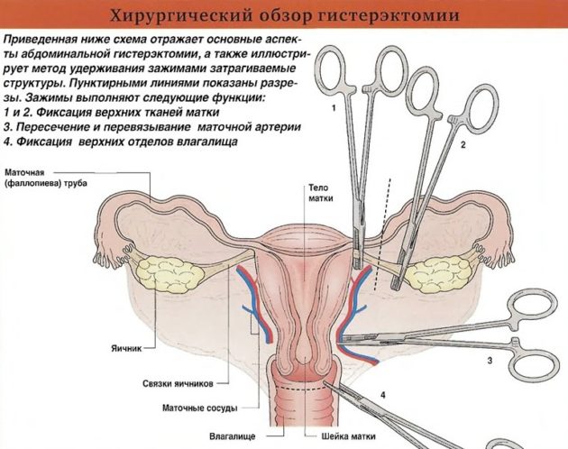 Чи йдуть місячні після видалення матки