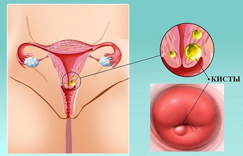 Що таке ретенційні кісти шийки матки