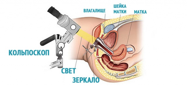 Що таке ретенційні кісти шийки матки