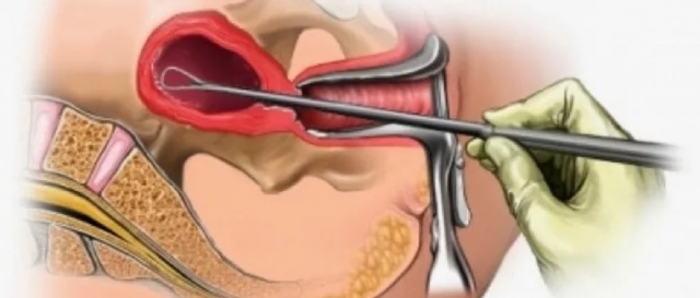 Вишкрібання порожнини матки при поліпи