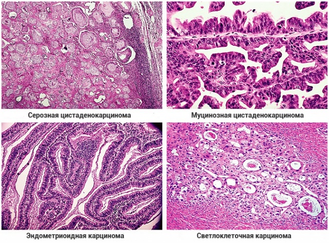 Що таке муцинозная аденокарцинома