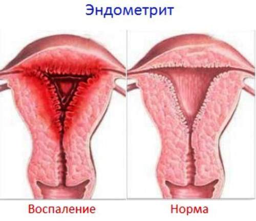 Місячні після кесаревого розтину